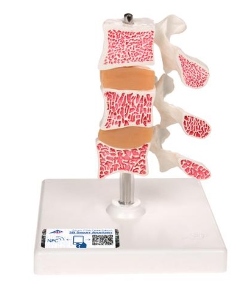 Model ľudských bedrových stavcov s osteoporózou 
