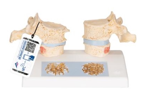 Didaktický model osteoporózy