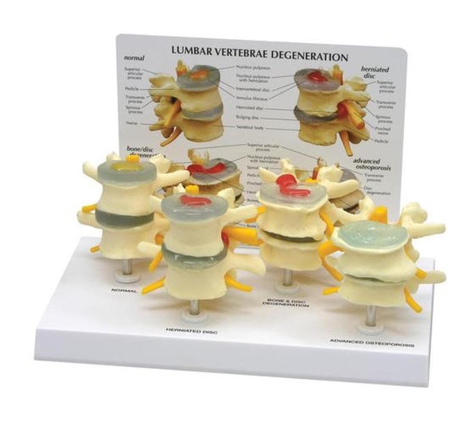 4-stupňový model stavcov