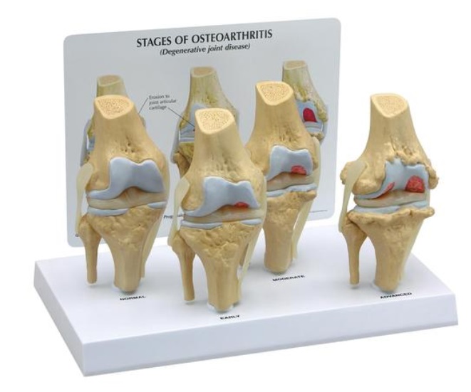 Kolenný kĺb, 4 stupne osteoartrózy